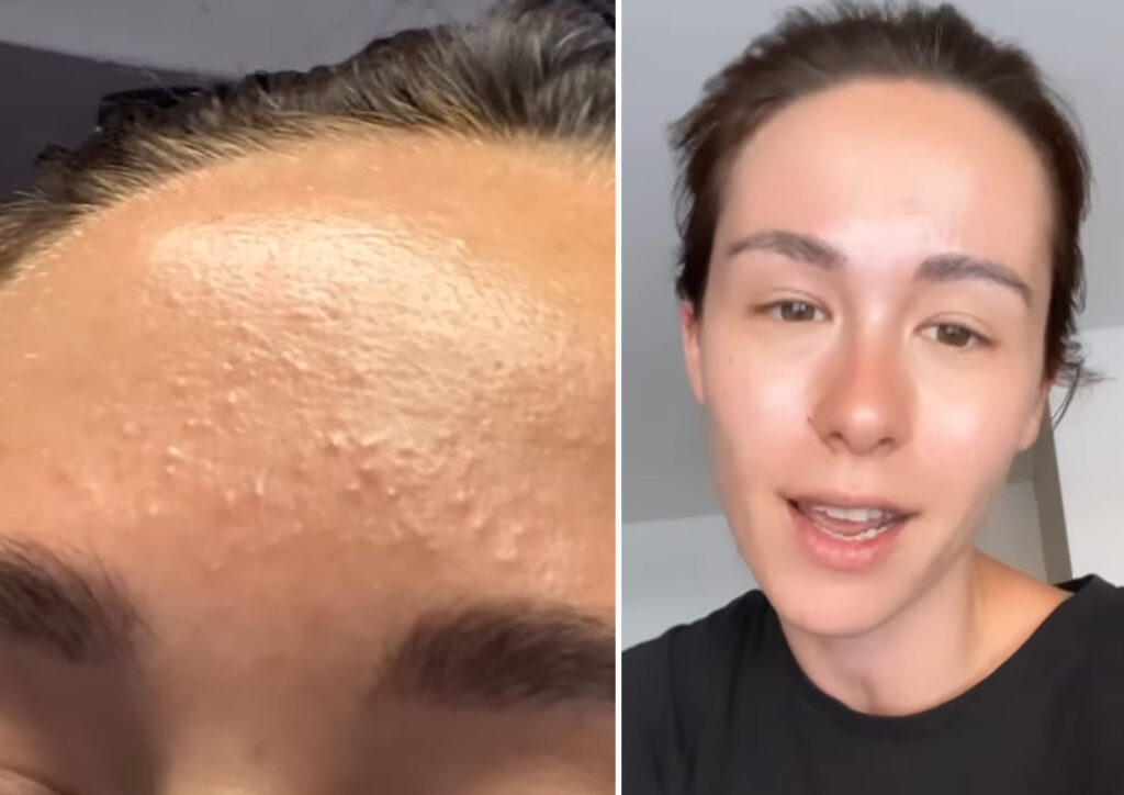 Aurora Ramazzotti 'allergica al sole': la reazione della pelle Aurora Ramazzotti 'allergica al sole': la reazione della pelle