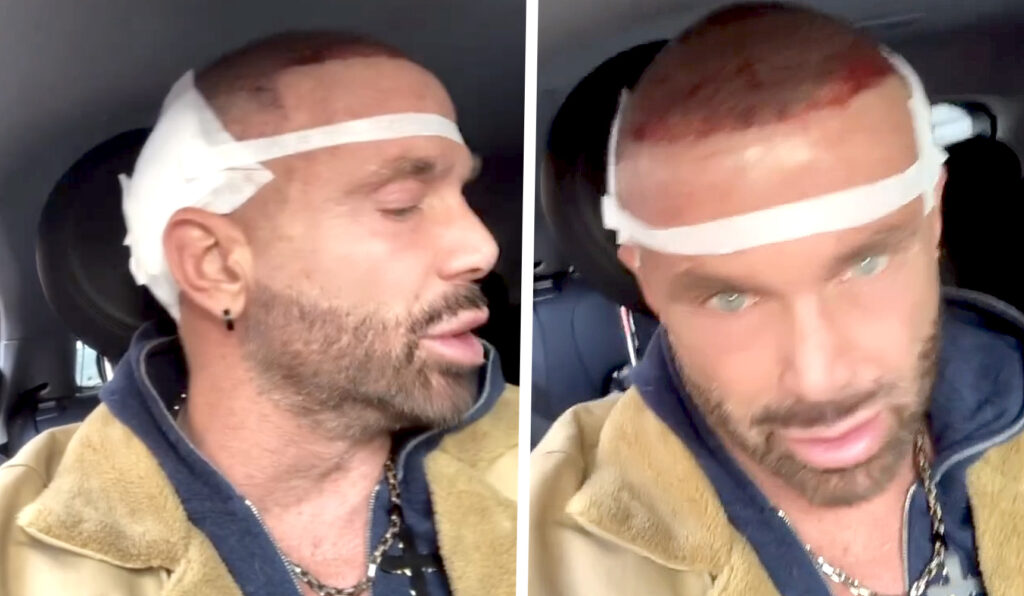 ''Dolori insopportabili e 10 ore di intervento'': Alex Nuccetelli si è operato per avere capelli più folti