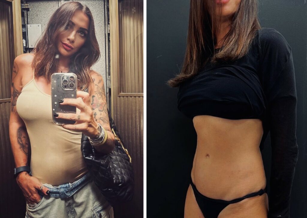 Irene Capuano, compagna di Francesco Arca, mostra il risultato dell'operazione chirurgica alla pancia: guarda