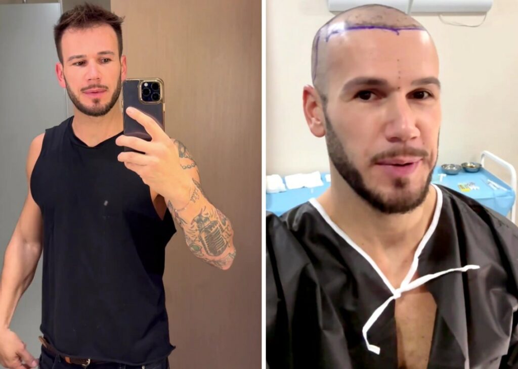 Matteo Diamante, ex Isola dei Famosi e GF, ha fatto il trapianto di capelli: le immagini post operatorie Matteo Diamante, ex Isola dei Famosi e GF, ha fatto il trapianto di capelli: le immagini post operatorie