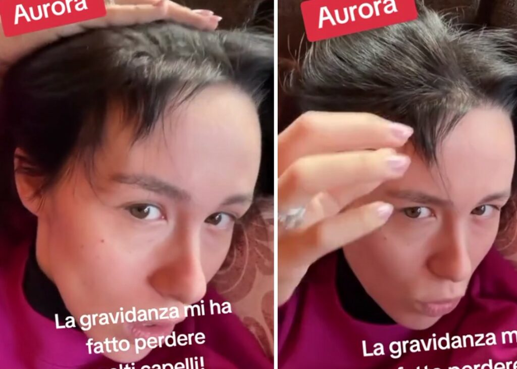 ''Dopo la gravidanza è successo questo'': Aurora Ramazzotti mostra la ricrescita asimmetrica dei capelli ''Dopo la gravidanza è successo questo'': Aurora Ramazzotti mostra la ricrescita asimmetrica dei capelli