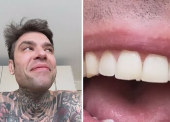 Le sfighe di Fedez continuano: il rapper mostra il danno al dente dopo l'allenamento