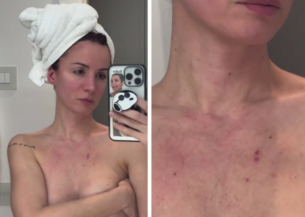 ''Mi sono dimenticata totalmente di collo e petto'': Andrea Delogu mostra i segni del tempo sulla pelle per non aver messo la crema solare ''Mi sono dimenticata totalmente di collo e petto'': Andrea Delogu mostra i segni del tempo sulla pelle per non aver messo la crema solare