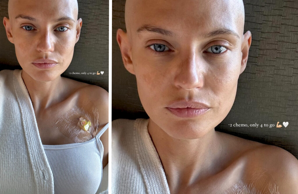 Bianca Balti si mostra mentre fa la seconda chemioterapia e rivela quante altre gliene mancano: foto Bianca Balti si mostra mentre fa la seconda chemioterapia e rivela quante altre gliene mancano: foto