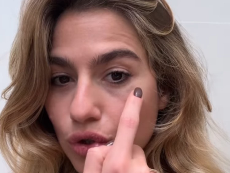 Cristina Marino mostra l’occhio nero dopo un incidente sul lavoro