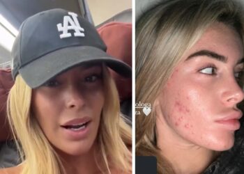 ''So cosa vuol dire evitare gli specchi'': Sophie Codegoni mostra il viso con forte acne e rivela di aver anche rimosso l'acido alle labbra