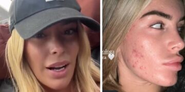 ''So cosa vuol dire evitare gli specchi'': Sophie Codegoni mostra il viso con forte acne e rivela di aver anche rimosso l'acido alle labbra