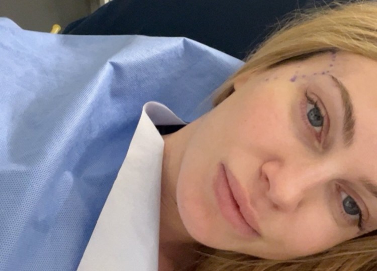 Taylor Mega si fa inserire un pò di grasso nelle tempie