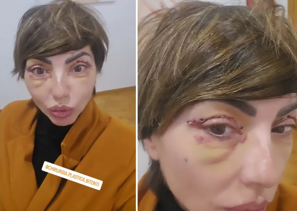 ''Ho tolto i punti'': l’ex Non è la Rai Ilaria Galassi si è sottoposta a un intervento di chirurgia estetica, ecco quale