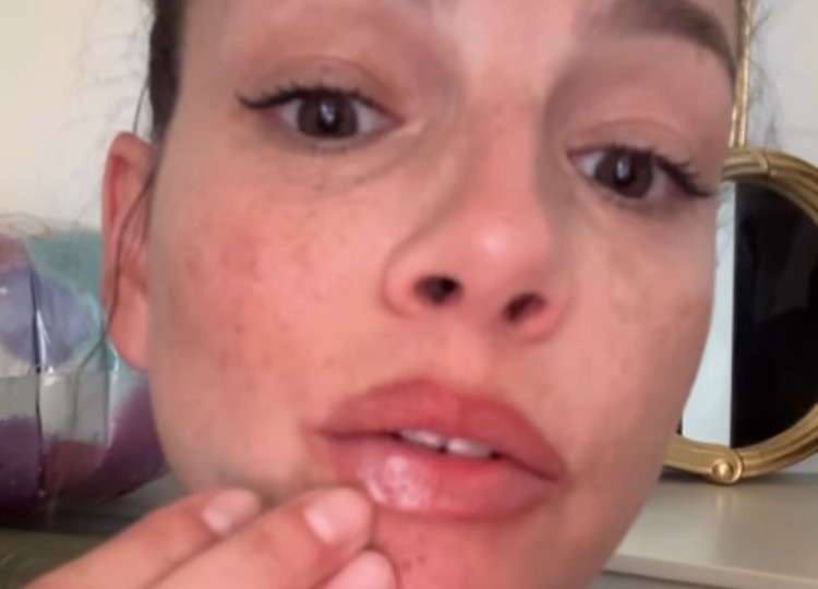 Emma Marrone e il solito herpes che le rovina i piani Emma Marrone e il solito herpes che le rovina i piani