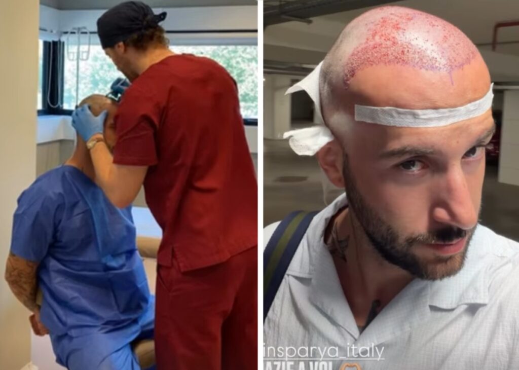 ''Non si torna più indietro!'': Andreas Muller ha deciso di risolvere il suo ‘problemino’ e si è sottoposto a un trapianto di capelli, guarda