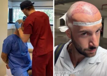 ''Non si torna più indietro!'': Andreas Muller ha deciso di risolvere il suo ‘problemino’ e si è sottoposto a un trapianto di capelli, guarda